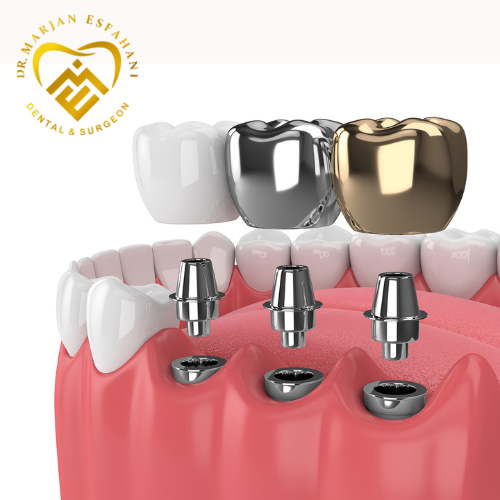 انواع مدل های ایمپلنت