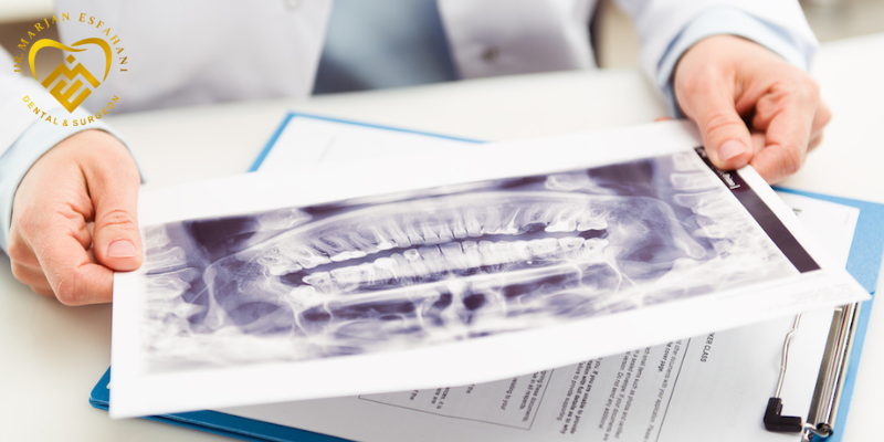 مهم ترین عوارض ایمپلنت