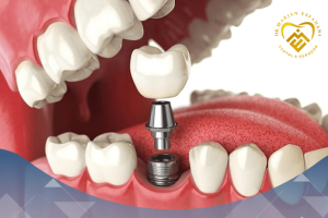 ایمپلنت چیست؟