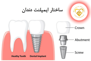 ساختار ایمپلنت دندان