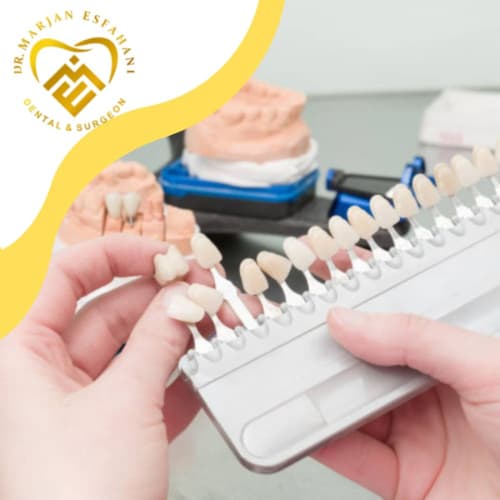 لمینت و انواع آن