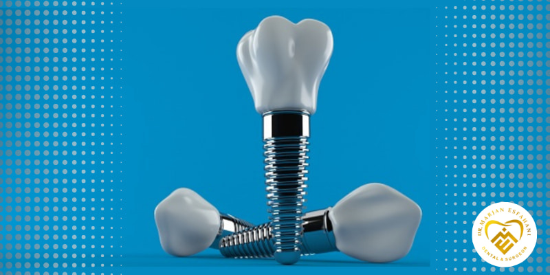 باید ها و نباید های انجام ایمپلنت