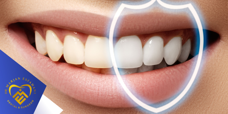 مزیت های انجام لمینت