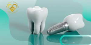 مزیت انجام ایمپلنت