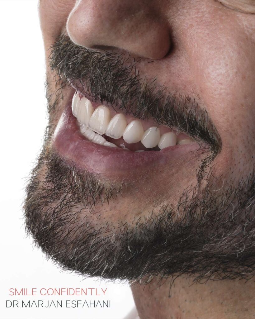 لمینت ایمکس
